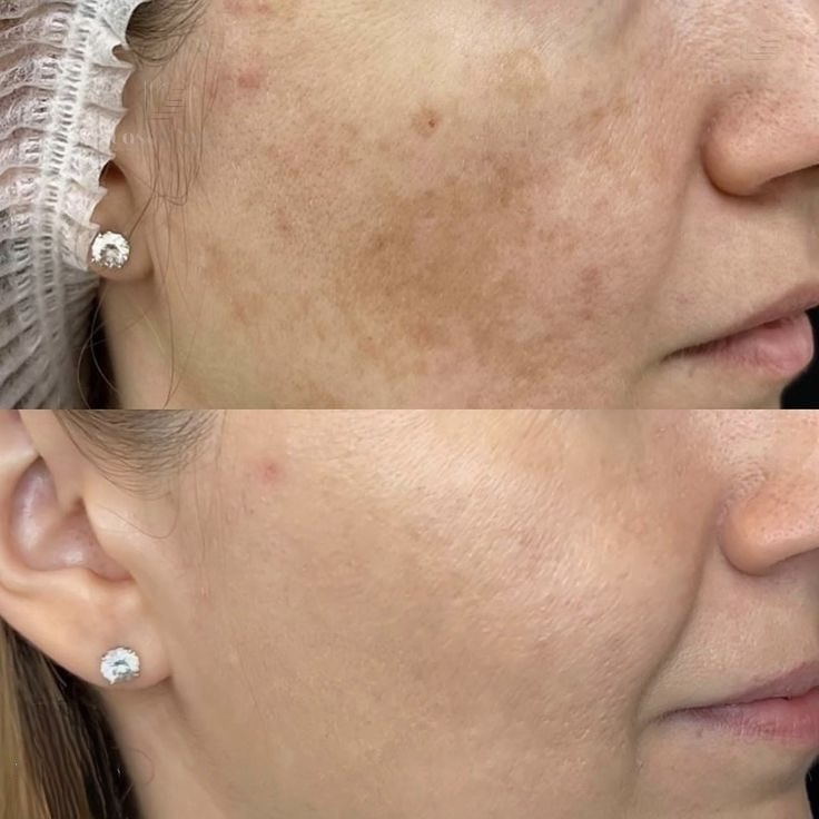 Comparativo de resultado de peeling