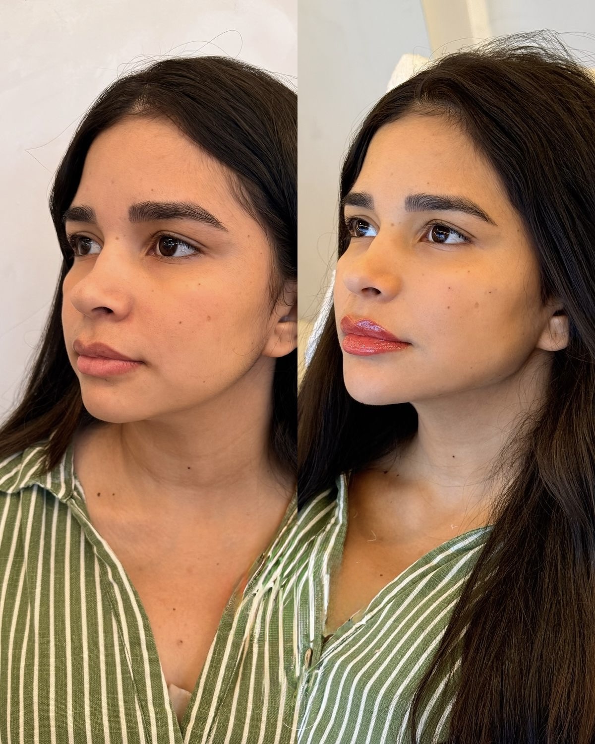 Comparativo de resultado de harmonização Fullface
